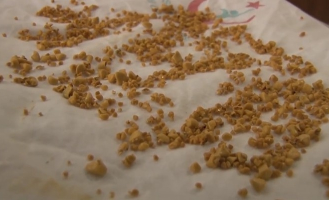 Şanlıurfa'da hastanın safra kesesinden bin 50 taş çıkarıldı