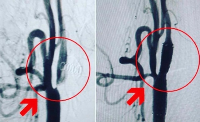 Şanlıurfa'da felçli hastaya başarılı müdahale yapıldı