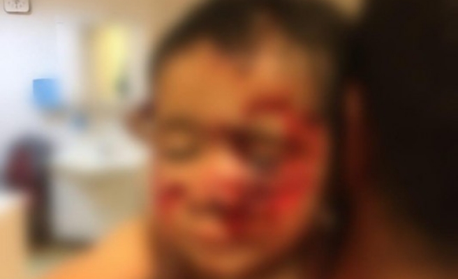 Şanlıurfa'da sokak köpekleri çocuklara saldırdı! 6 yaralı