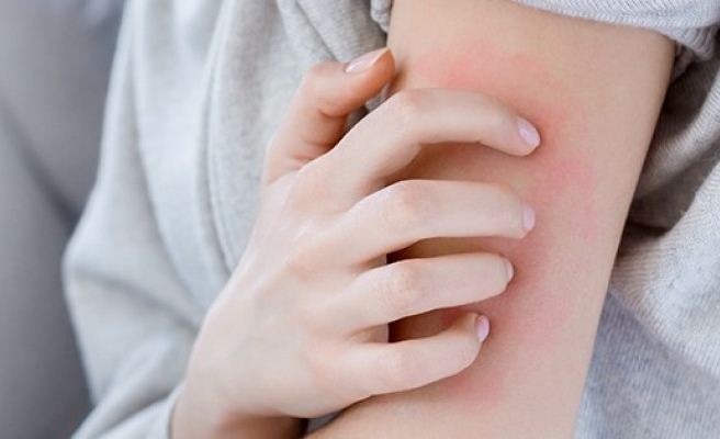 Şanlıurfa'da uyuz vakalarında artış