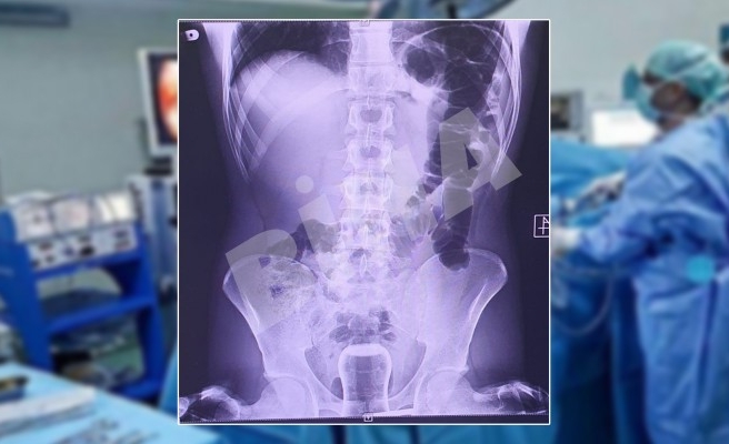 Şanlıurfa’da ilginç ameliyat!