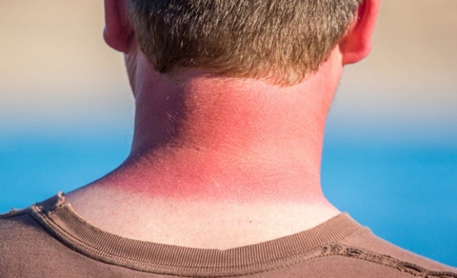 Güneş yanığının etkilerini azaltacak 12 uyarı