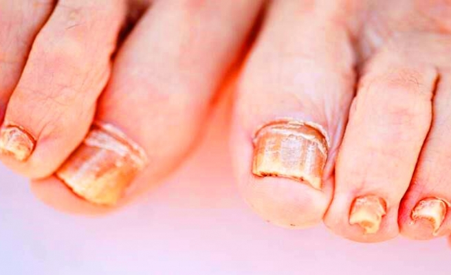 Dermatoloji uzmanı uyardı! Tırnak tümörleri tırnak mantarıyla karışabiliyor