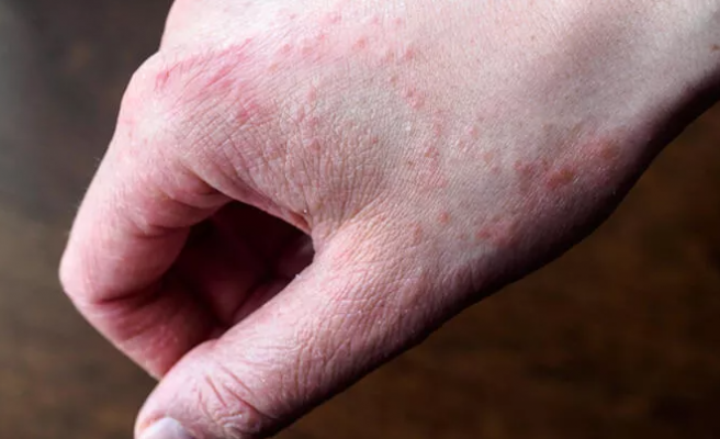 El dezenfektanları egzamaya davetiye çıkarıyor