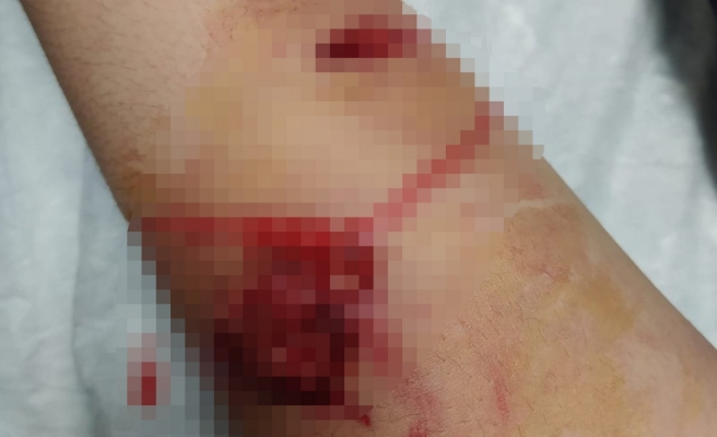 Urfa'da köpek saldırısı! Genç kadın yaralandı