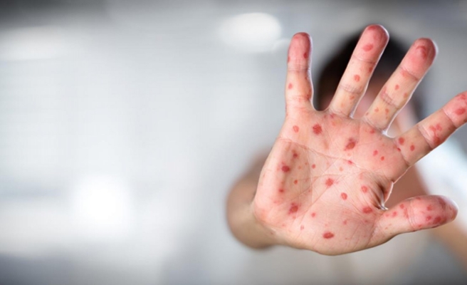 Bakanlıktan dünyayı sarsan 'maymun çiçeği' hastalığı açıklaması