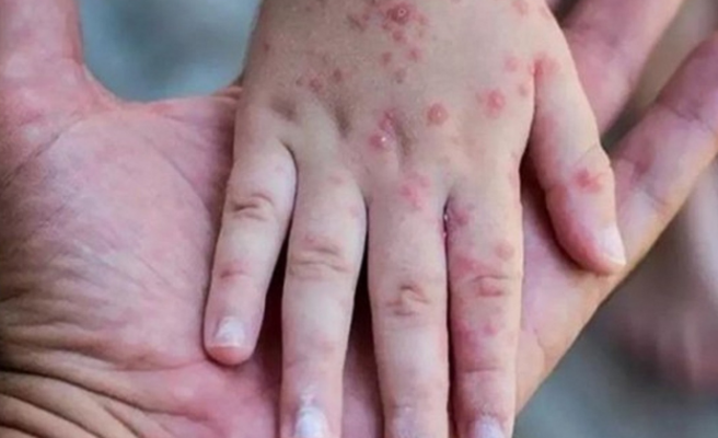 Bakan Koca'dan maymun çiçeği virüsü açıklaması