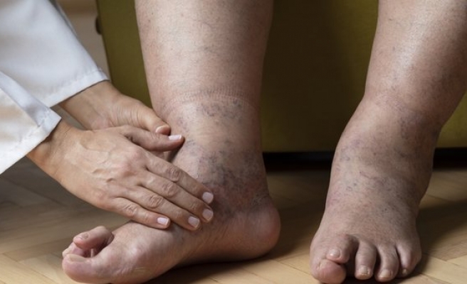 5 maddede vücuttan ödemi at!