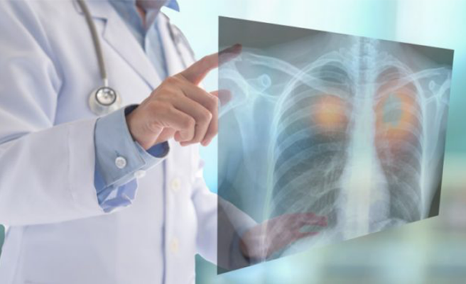 Urfa'da da artan verem hastalığının sebepleri açıklandı