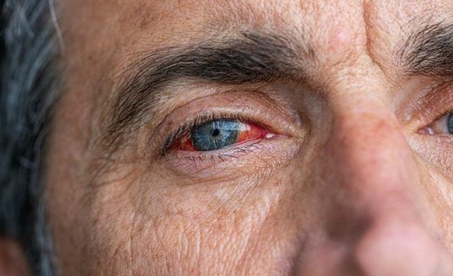 Glokomda erken tedavi görme kaybını engelliyor