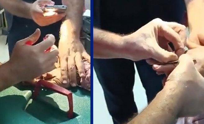 Parmağa sıkışan yüzüğü hastanede doktor çıkardı