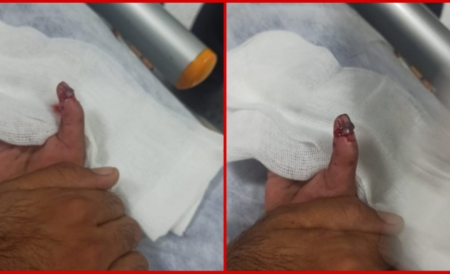 Urfa’da küçük kız oyun oynarken parmağından oluyordu