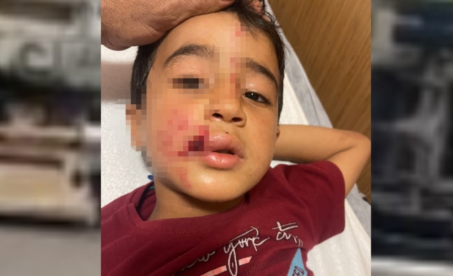 Şanlıurfa'daki çocuğu sokak köpeği ısırdı!